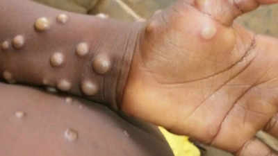 GHS takes measures to check Mpox outbreak - Nsemkeka