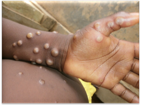 Ghana Records Third Mpox Case in 2025 - GhArticles.com