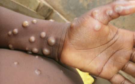 Ghana Reports 34 New Mpox Cases, Total Infections Reach 79 - GhArticles.com